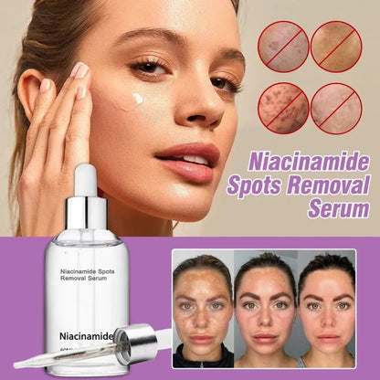 🎉Buy One Get One Free🔥Hot Sale 49% Off🎁 - 10% Niacinamide Spots Removal Serum