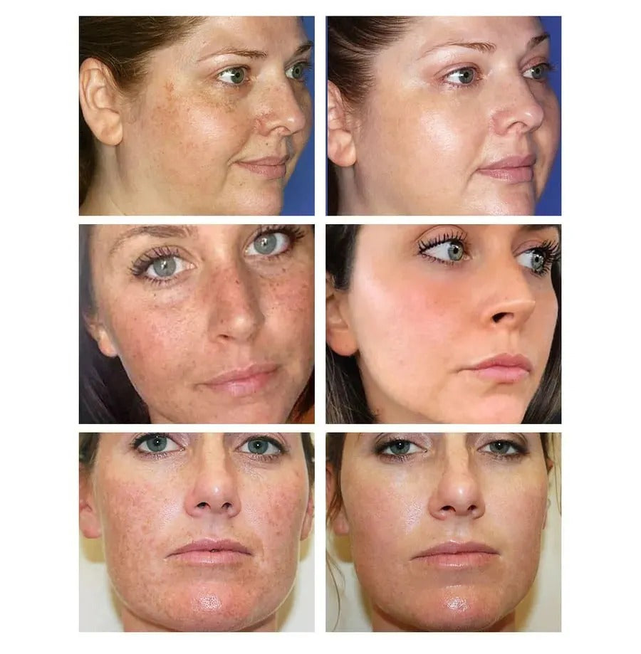 🎉Buy One Get One Free🔥Hot Sale 49% Off🎁 - 10% Niacinamide Spots Removal Serum
